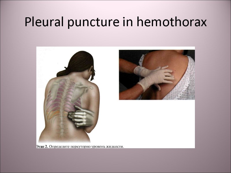 Pleural puncture in hemothorax